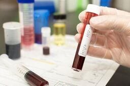 توضیحات لازم درباره افشای اطلاعات محرمانه بیماران HIV در آزمایشگاه‌ها